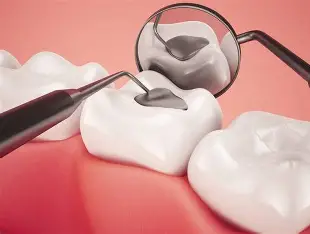 Fillings & Sealants